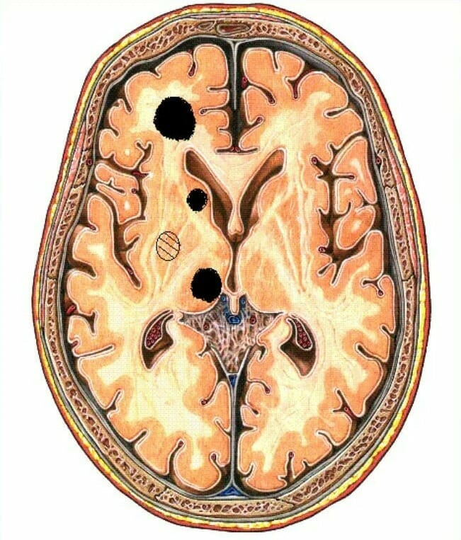 Encephalopathy